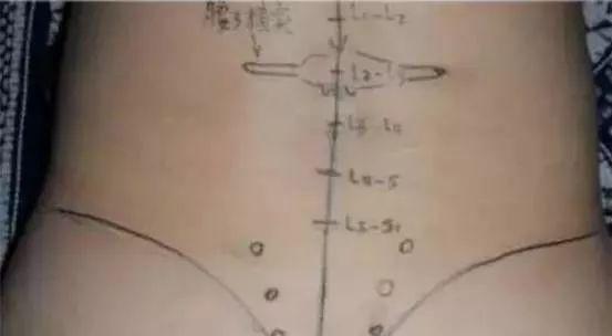 大粗针刀视频,传统中医针灸的神奇疗效与操作技巧
