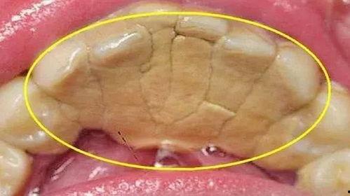 去除牙结石视频,专业视频教学解析